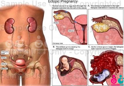 ectopic_pregnancy----.jpg