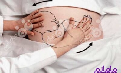 حالت بریچ نوزاد چه تاثیری در زایمان دارد؟ (بخش دوم)