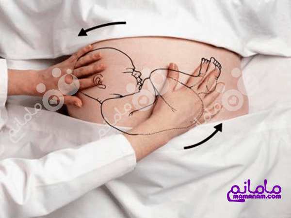 حالت بریچ نوزاد چه تاثیری در زایمان دارد؟ (بخش دوم)