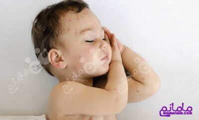5 روش موثر در درمان گزش و نیش حشرات در کودکان