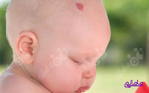 Neurofibromatosis2.jpg