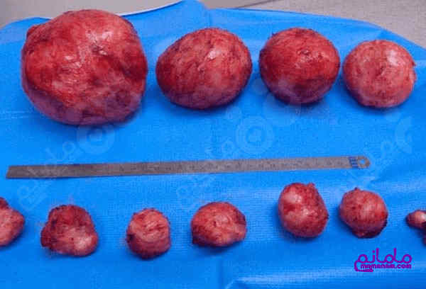 fibroid3-1.jpg