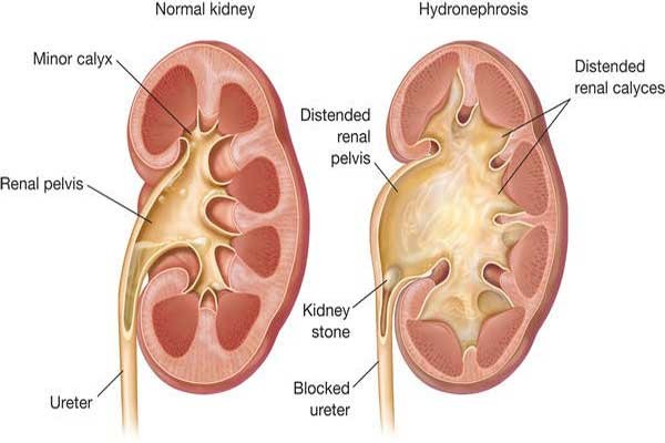 b2ap3 large hydronephrosis 20170709 064059 1