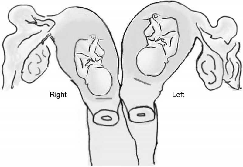 b2ap3 large Double singleton pregnancies in double uterus 1534227097 12057