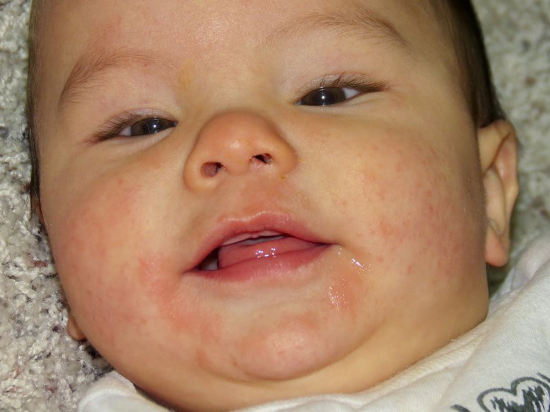 b2ap3 large allergy symptos 1533195058 97944