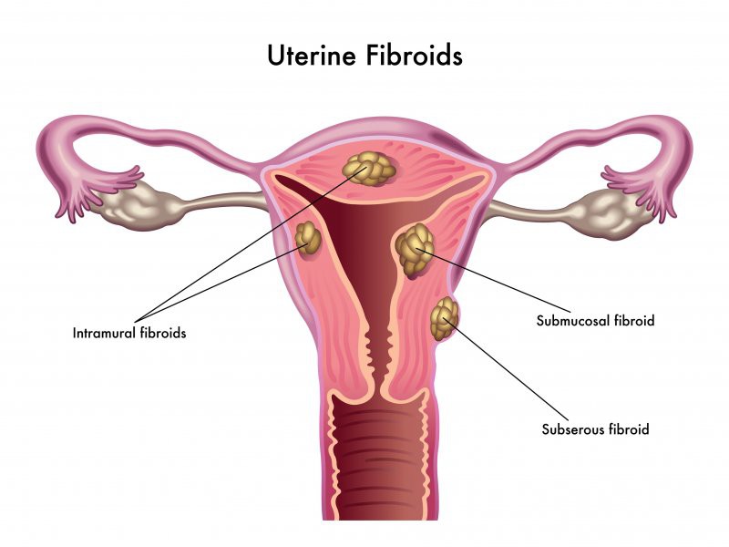 b2ap3 large fibroids 1 0 1533658437 96805