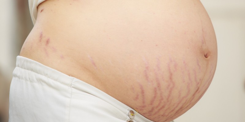 b2ap3 large o STRETCH MARKS PREGNANCY facebook 1534321071 51553