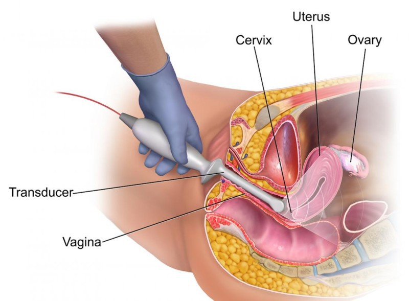 b2ap3 large diagram of transvaginal ultrasound br image credit bruceblaus 2015 br