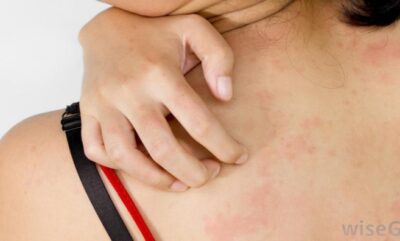 علت بروز کهیر در بارداری چیست؟