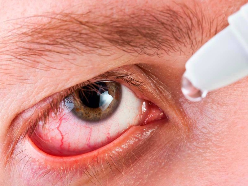 b2ap3 large blog dry eye 2