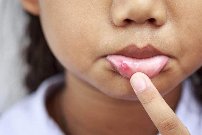 b2ap3 large canker sore