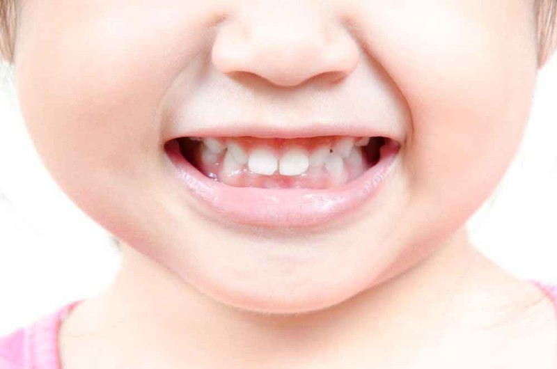 b2ap3 large smile with baby teeth