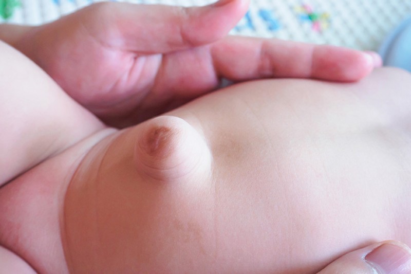 b2ap3 large Hernia In Babies