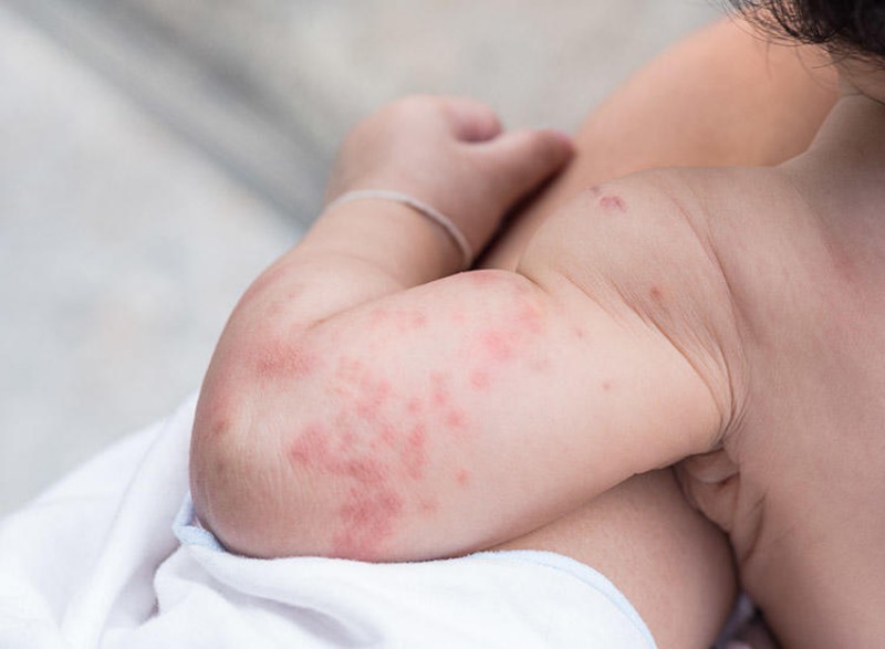 b2ap3 large hives baby rash