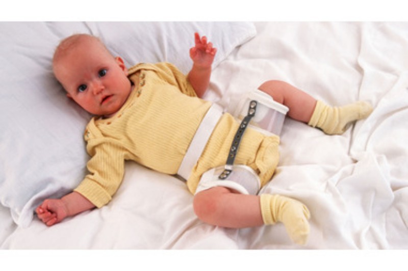 b2ap3 large Baby with hip dysplasia