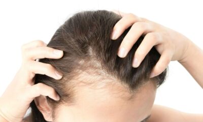 عوارض کاشت مو در زنان چیست ؟