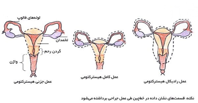 برداشتن رحم