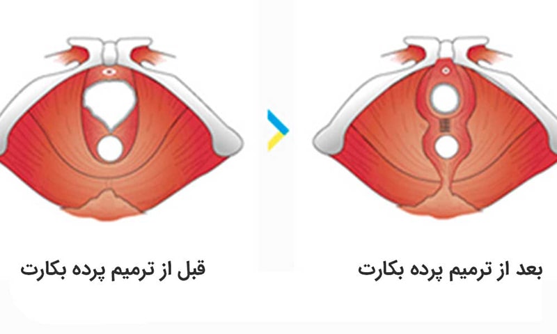 ترمیم پرده بکارت