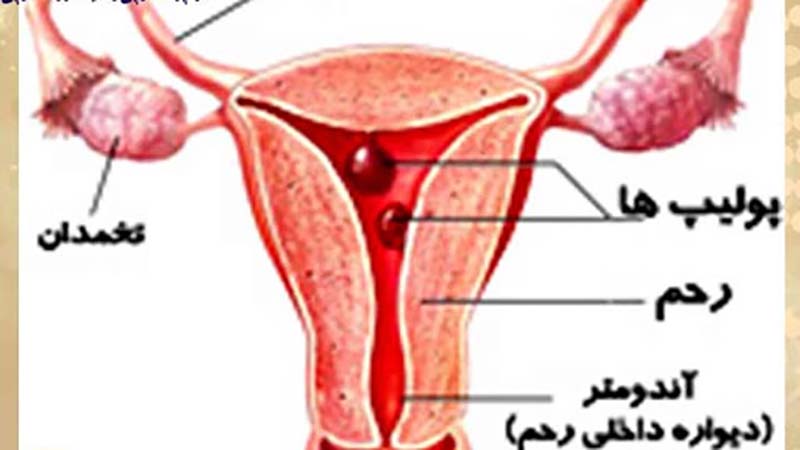 پولیپ رحم