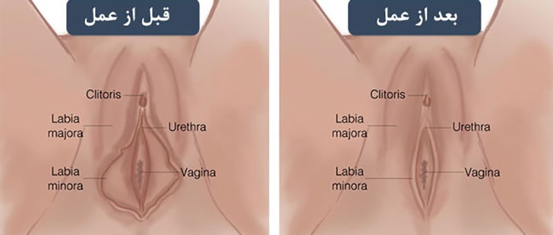 جراحی زیبایی واژن